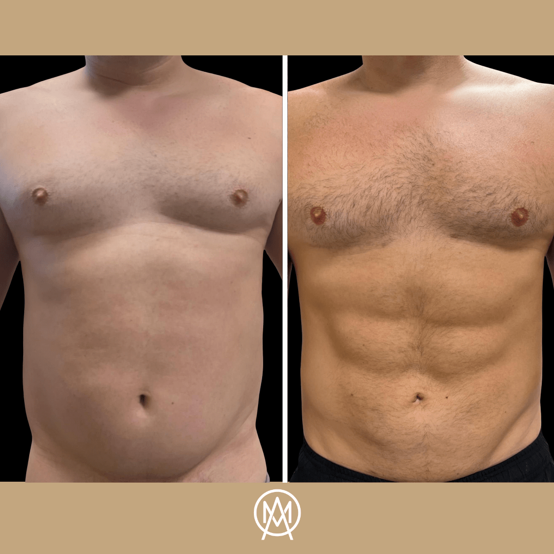 Male torso before and after abdominal etching — defined abdominal muscles on the after frame
