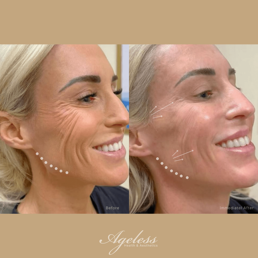 Three-quarter view before and after dermal filler — softened contours on the after frame
