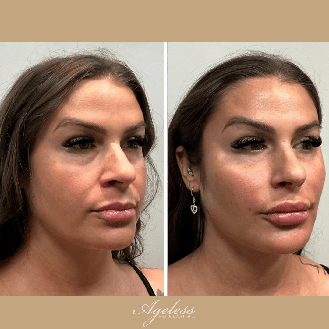 Three-quarter view before and after lip filler — fuller lips and enhanced profile after
