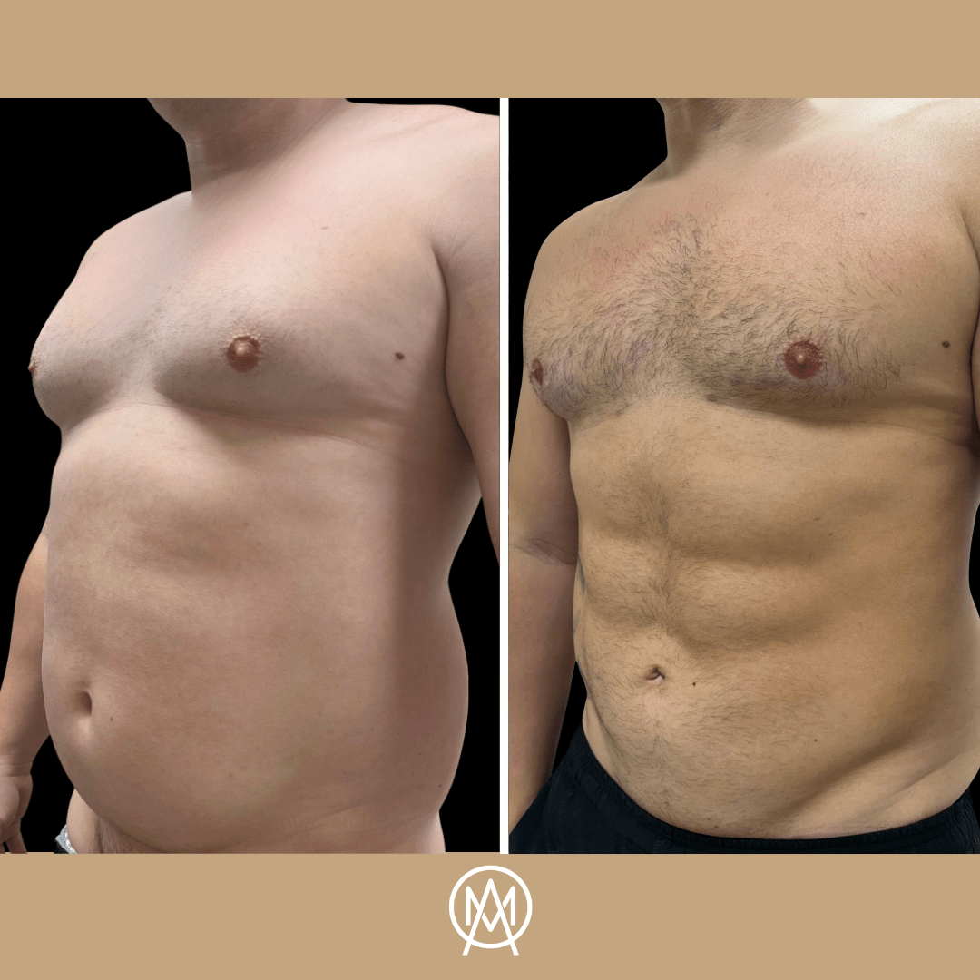 Male torso at an oblique angle before and after abdominal etching — defined contours on the after frame