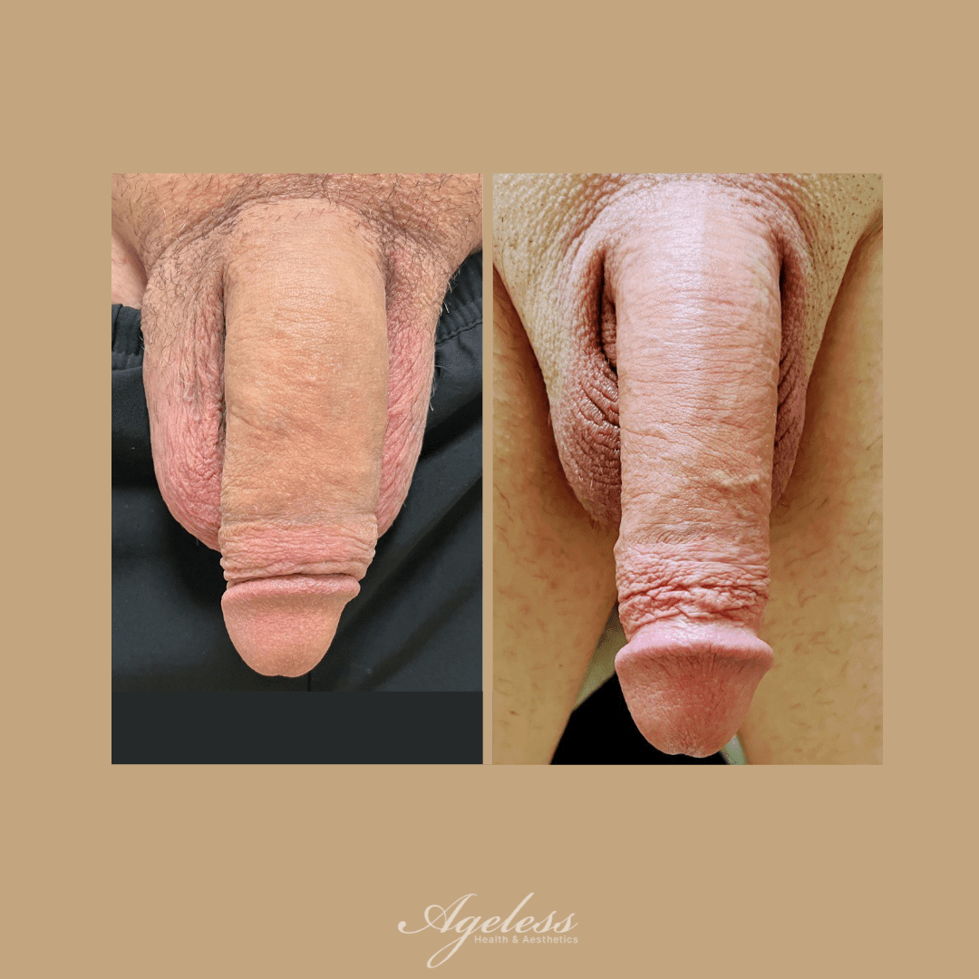 Clinical before and after of penile girth enhancement with filler — increased girth after