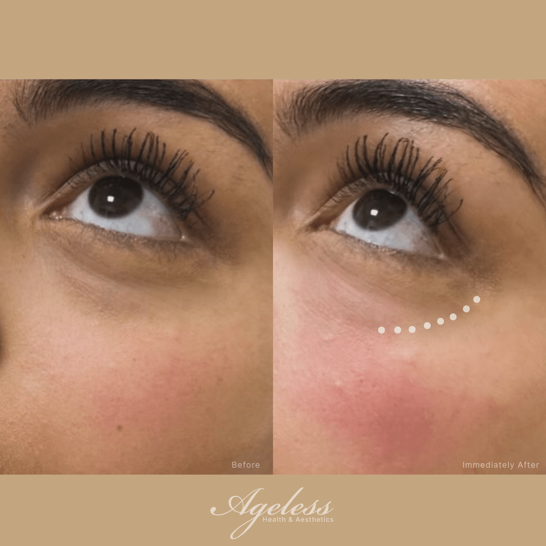 Under-eye area before and immediately after PRFM treatment — reduced hollowing after