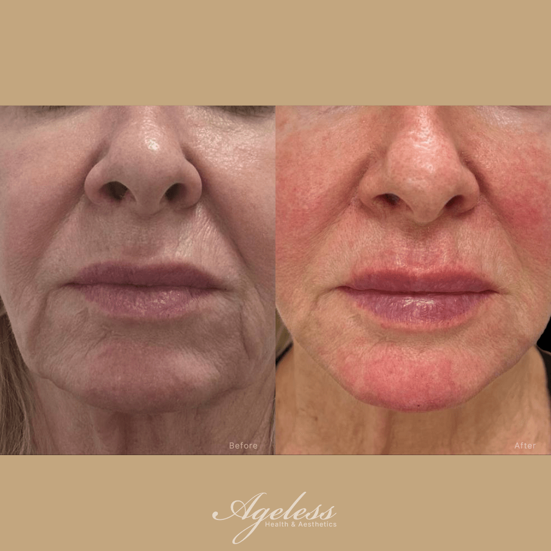 Lower face before and after a thread lift, front view — before on the left, after on the right