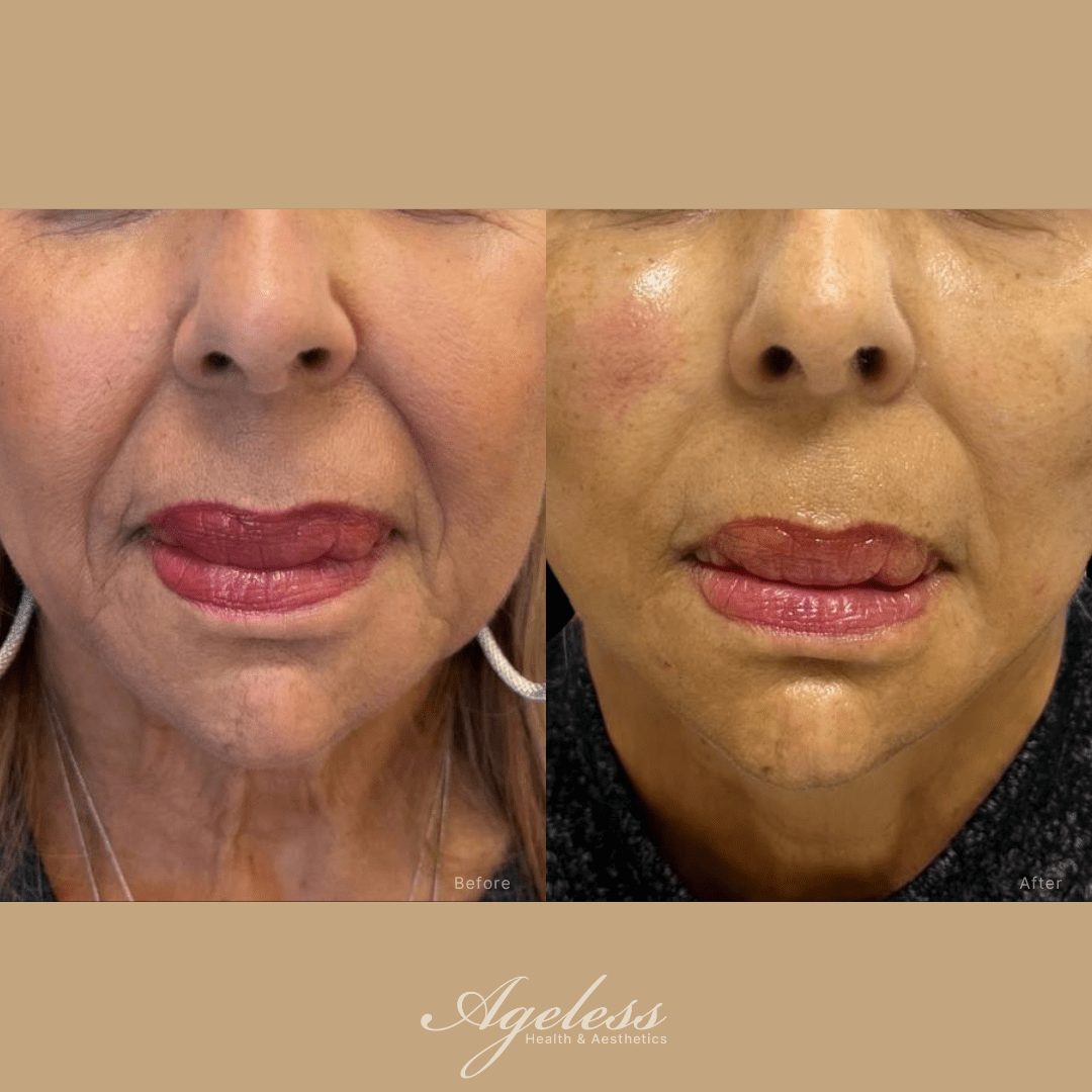 Mouth, chin and neck before and after a lower-face thread lift — before on the left, after on the right