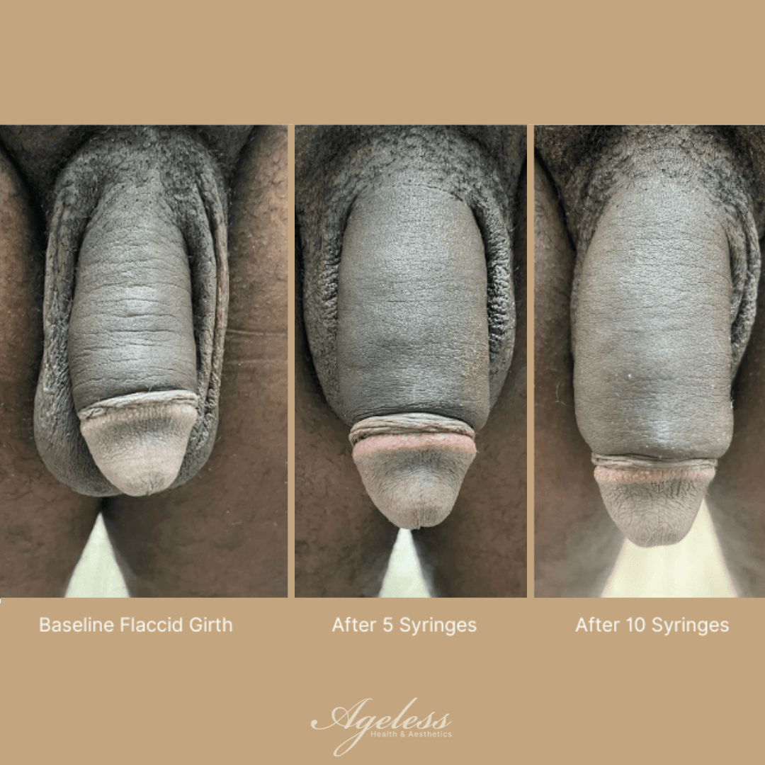 Clinical progression of penile girth enhancement: baseline, after five syringes, and after ten syringes