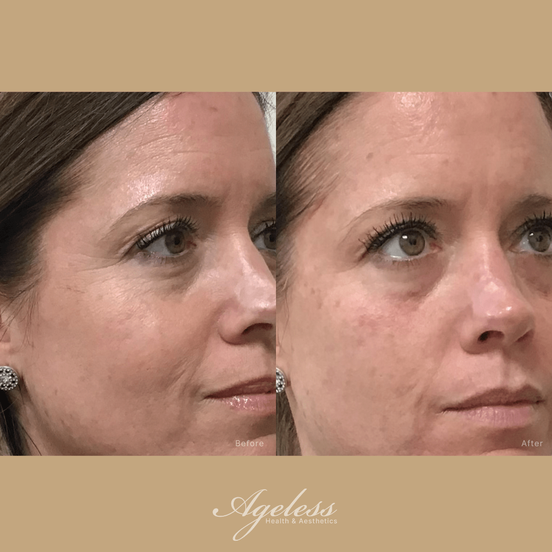 Before and after of a glass skin facial — smoother, more luminous skin after