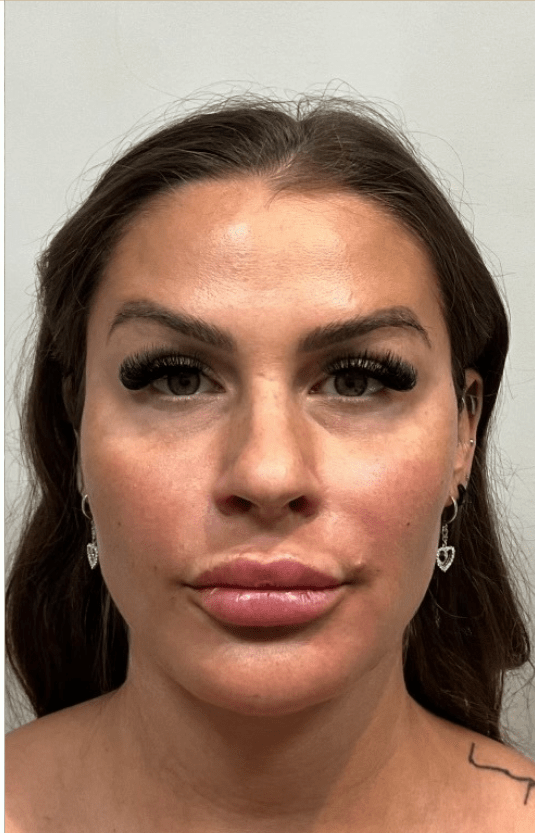 The same patient after lip filler, front view