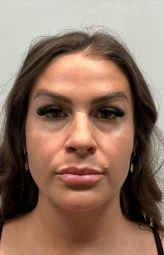 Patient before lip filler, front view
