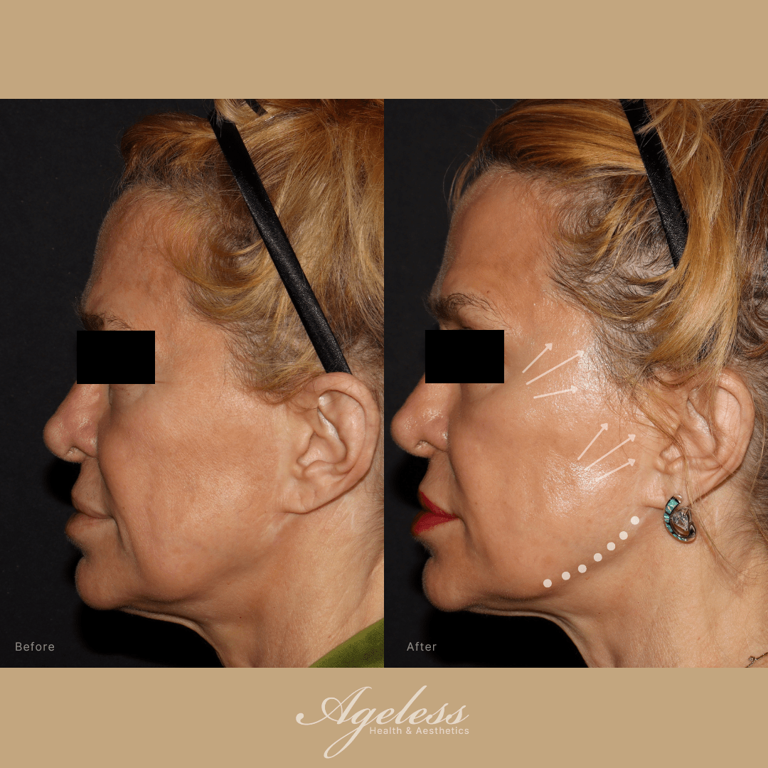Before and after of a jawline thread lift in left profile — lifted jawline and cheek on the after frame