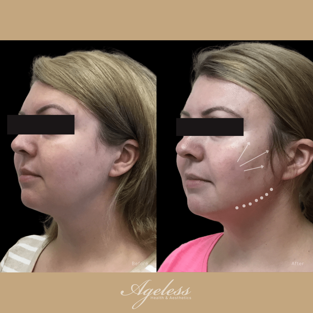 Before and after of a PDO thread lift in three-quarter profile, with lift-direction markings on the after frame