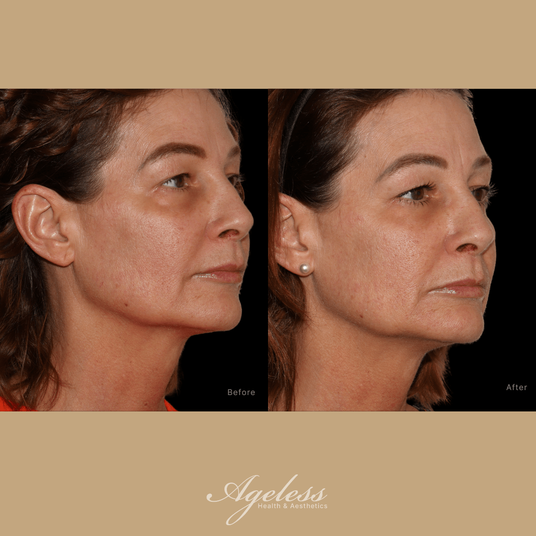 Before and after of a PRP facial at a 45-degree angle — smoother skin and improved mid-face contour after